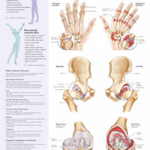 Understanding Arthritis Chart