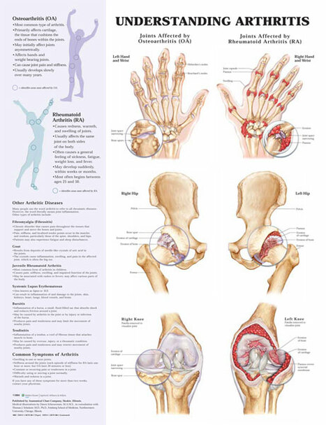 Understanding Arthritis Chart
